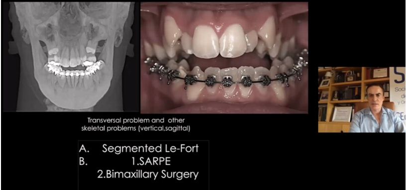 Ca lâm sàng loại III nặng điều trị nắn chỉnh răng phối hợp nong hàm trên hỗ trợ bởi phẫu thuật; sau đó được phẫu thuật chỉnh hình xương